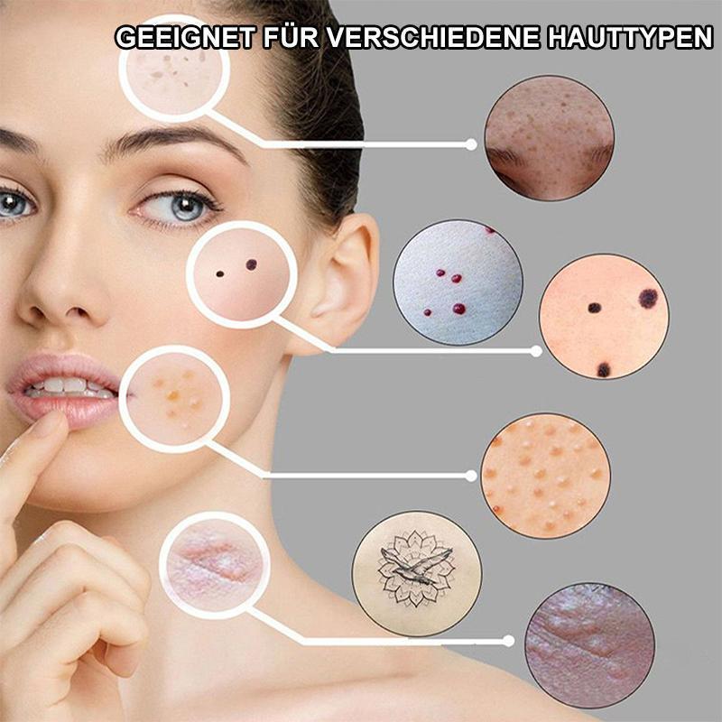 Laser Treatment Pen Blu-Ray for Removing Unwanted Acne