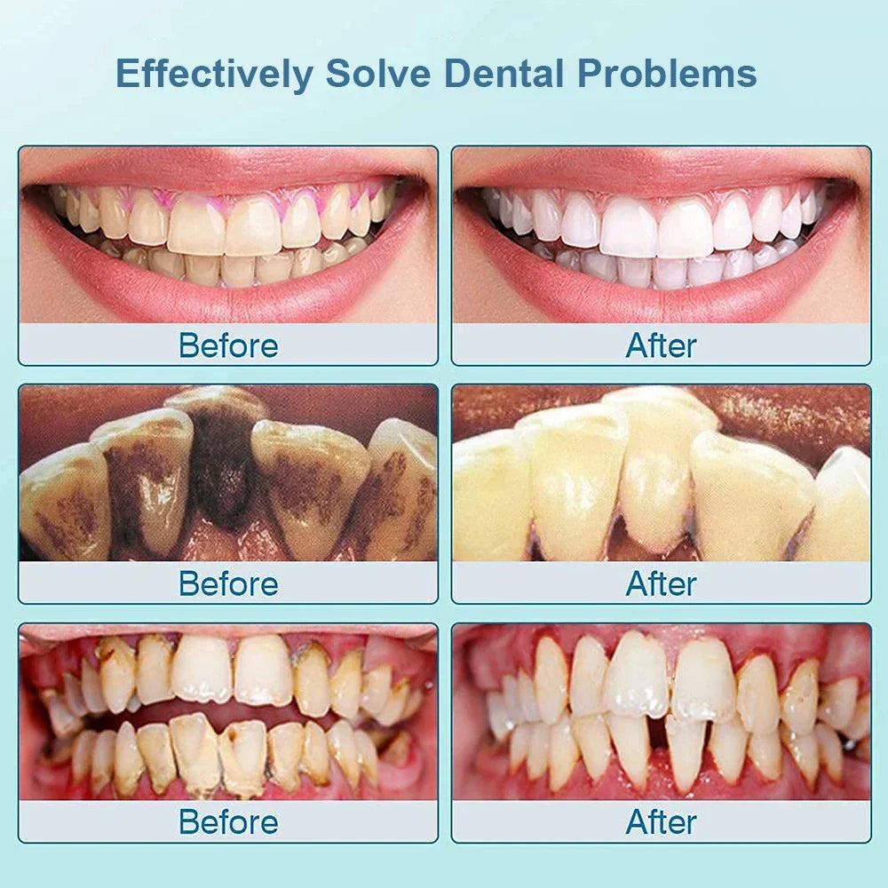 Ultrasone Tooth Cleaner - SonicClean